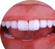 Braces