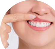 Braces